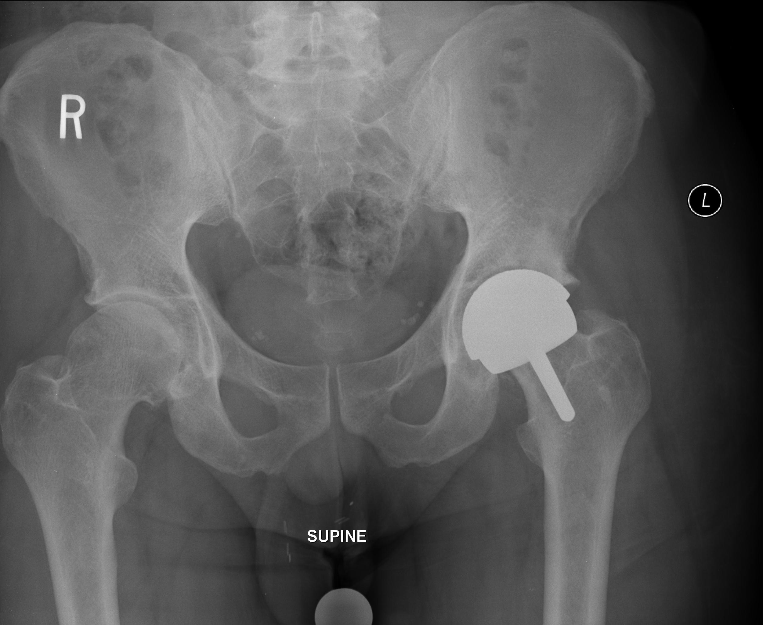 xray of a normal hip joint