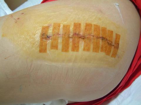 Vicky's 4 inch incision 4 days post op