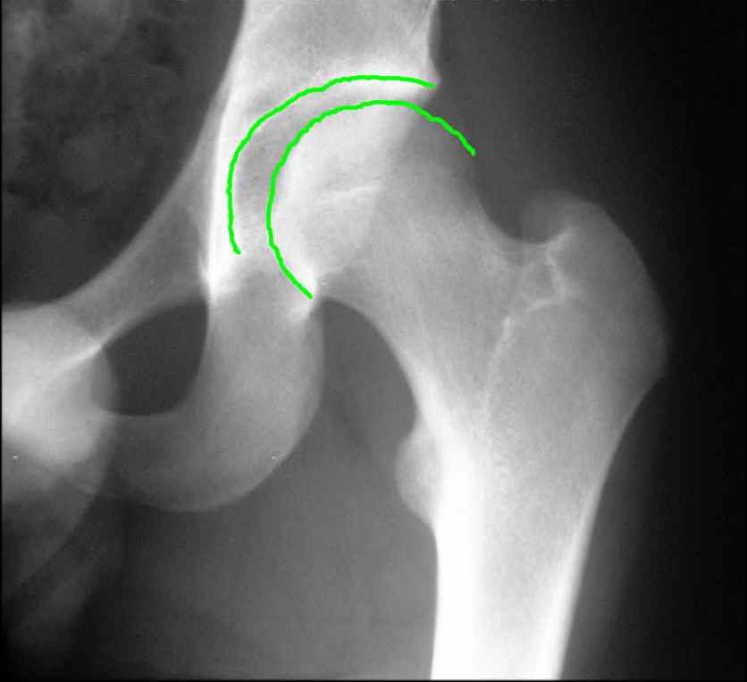 xray of normal hip joint vs osteoarthritic